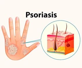 ¿Qué es la psoriasis y por qué es peligrosa 